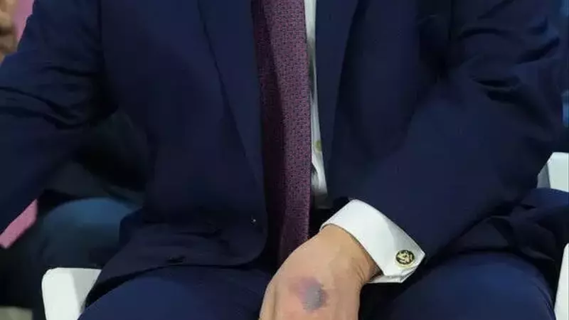 Trump Explains Hand Bruise Amid Health Speculation